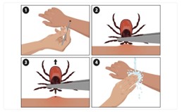 Use pointed tweezers to grasp the tick as close to the skin as possible. Pull it straight out. Clean the area afterward with rubbing alcohol or soap and water.